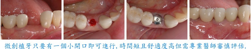 微創植牙流程四張連續照片