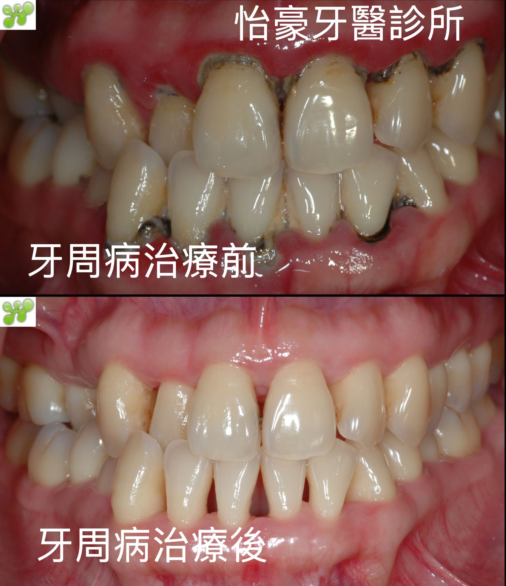 牙周病治療前後完整案例