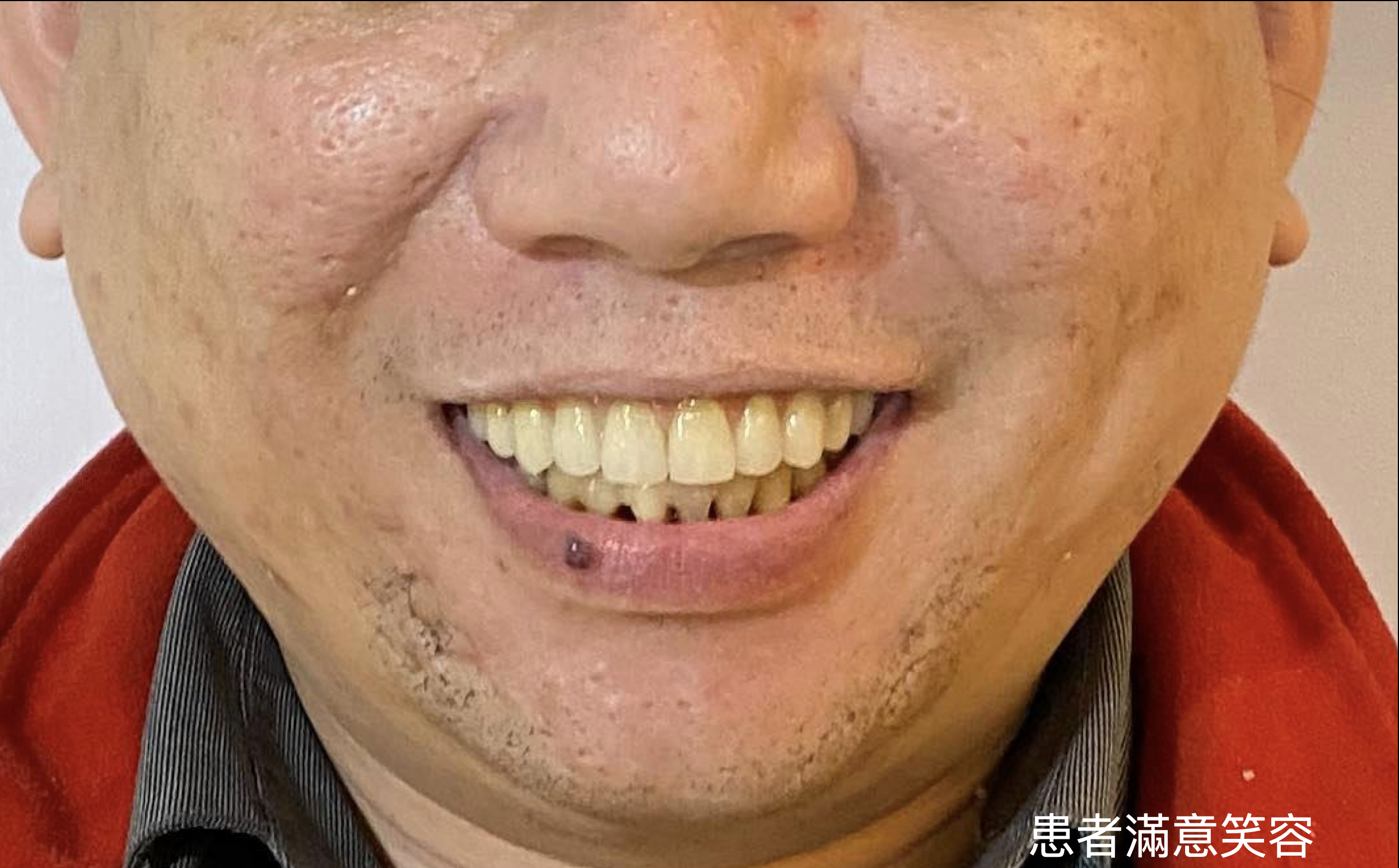 All-on-4 患者滿意笑容